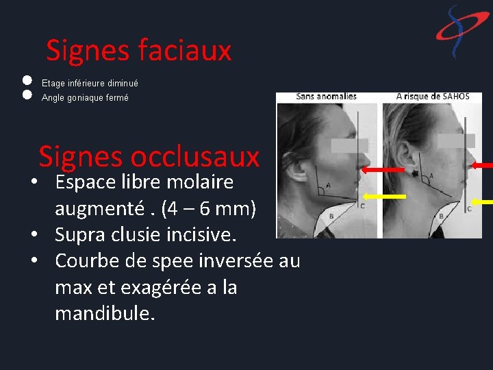 ● ● Signes faciaux Etage inférieure diminué Angle goniaque fermé Signes occlusaux • Espace