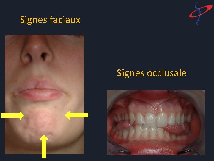 Signes faciaux Signes occlusale 