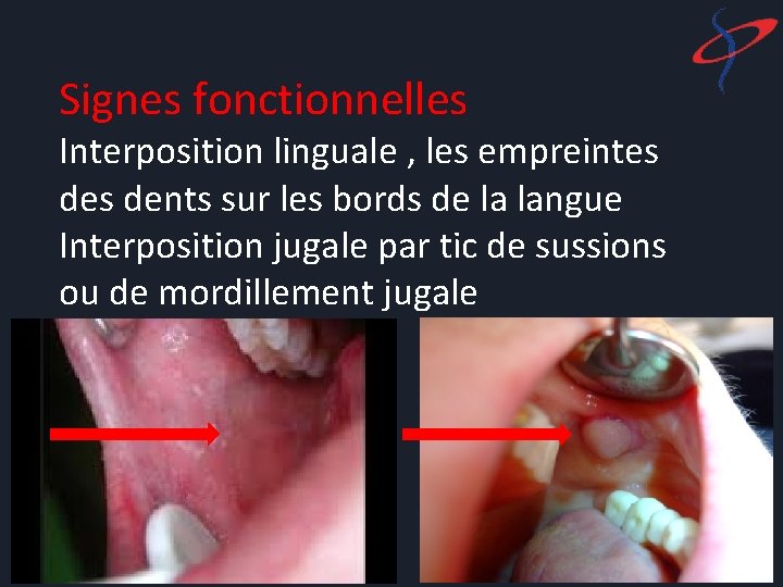 Signes fonctionnelles Interposition linguale , les empreintes dents sur les bords de la langue