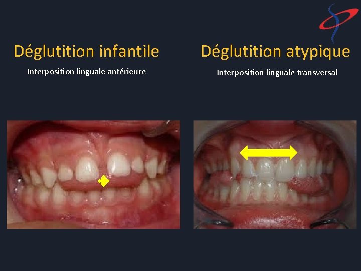 Déglutition infantile Déglutition atypique Interposition linguale antérieure Interposition linguale transversal 