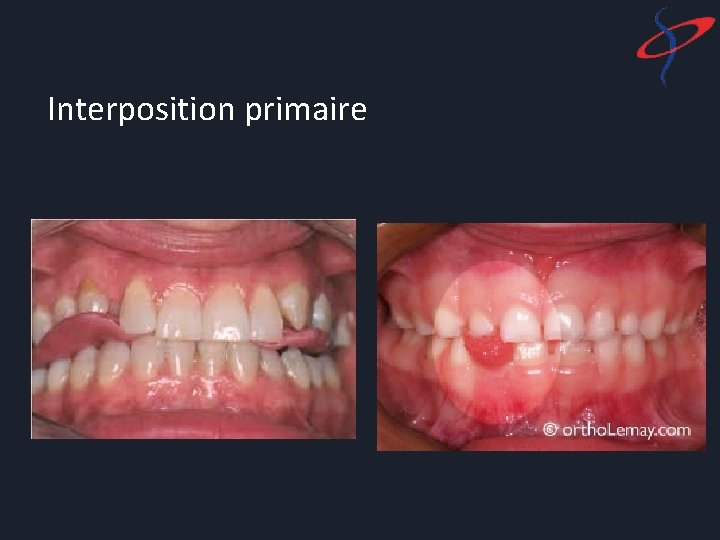 Interposition primaire 