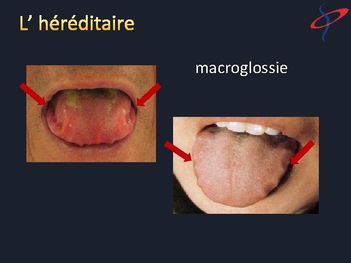 L’ héréditaire macroglossie 