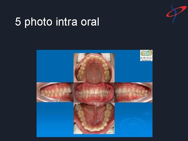 5 photo intra oral 