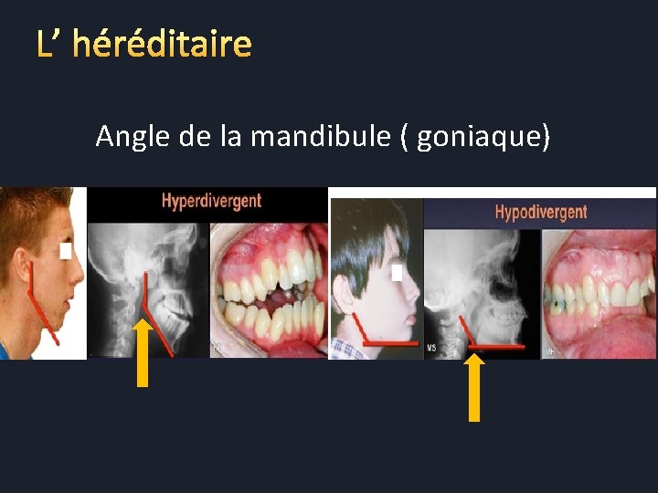 L’ héréditaire Angle de la mandibule ( goniaque) 