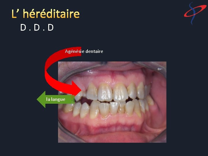 L’ héréditaire D. D. D Agénésie dentaire la langue 