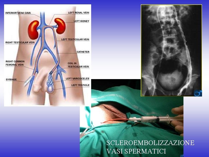 SCLEROEMBOLIZZAZIONE VASI SPERMATICI 