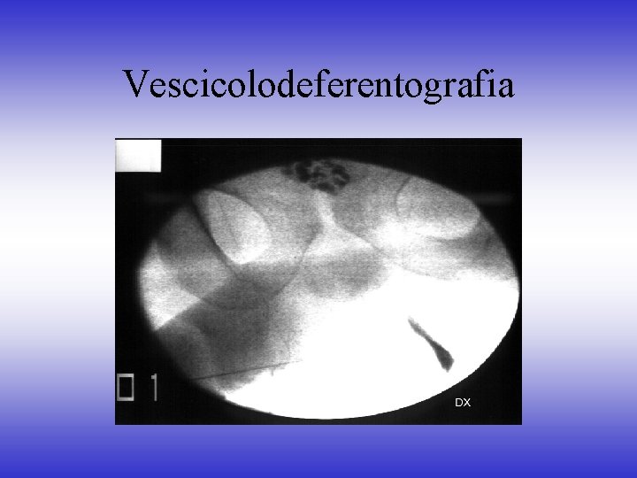 Vescicolodeferentografia 