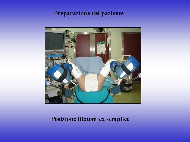 Preparazione del paziente Posizione litotomica semplice 