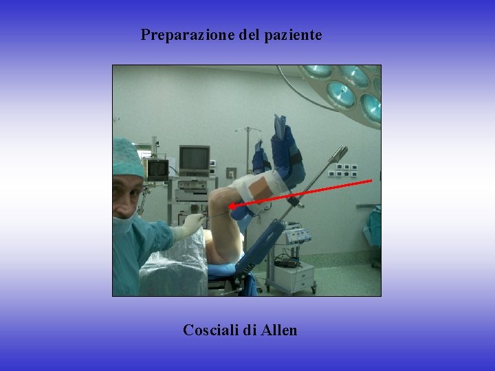 Preparazione del paziente Cosciali di Allen 