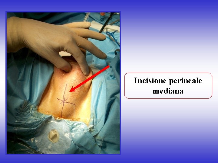 Incisione perineale mediana 