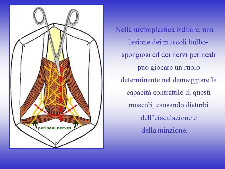 Nella uretroplastica bulbare, una lesione dei muscoli bulbospongiosi ed dei nervi perineali può giocare