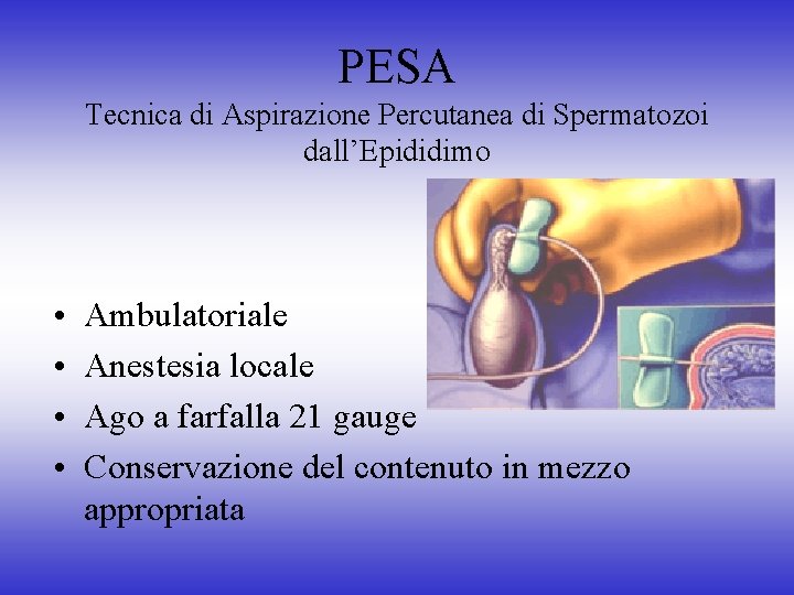 PESA Tecnica di Aspirazione Percutanea di Spermatozoi dall’Epididimo • • Ambulatoriale Anestesia locale Ago