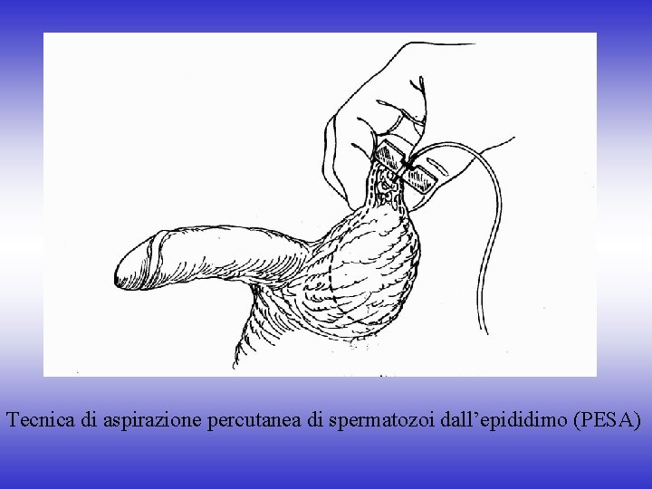 Tecnica di aspirazione percutanea di spermatozoi dall’epididimo (PESA) 