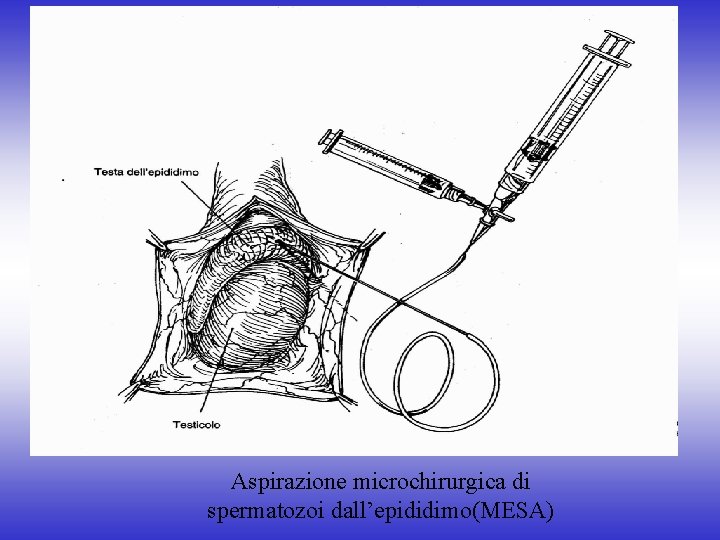 Aspirazione microchirurgica di spermatozoi dall’epididimo(MESA) 