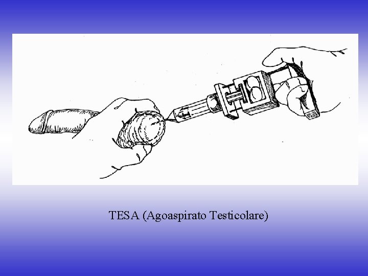 TESA (Agoaspirato Testicolare) 