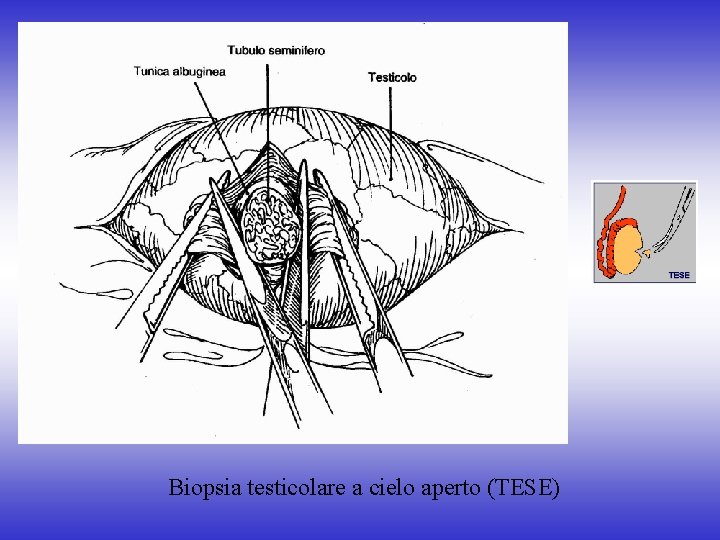 Biopsia testicolare a cielo aperto (TESE) 