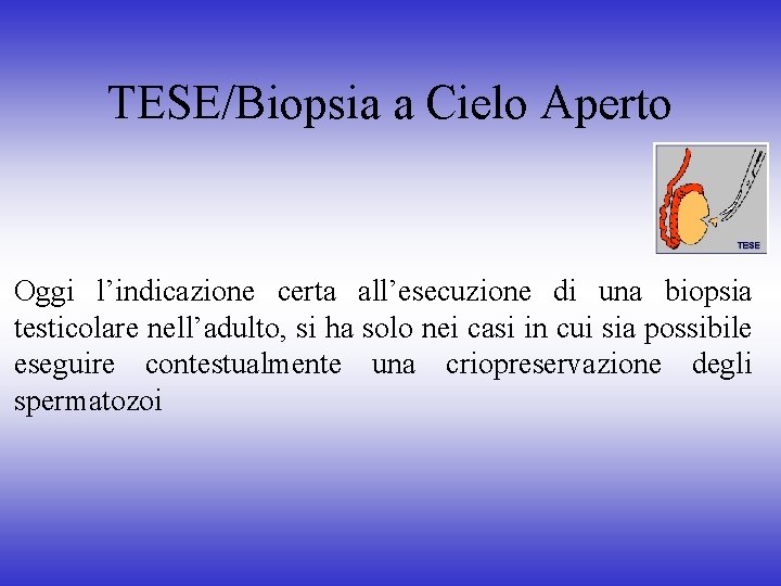 TESE/Biopsia a Cielo Aperto Oggi l’indicazione certa all’esecuzione di una biopsia testicolare nell’adulto, si