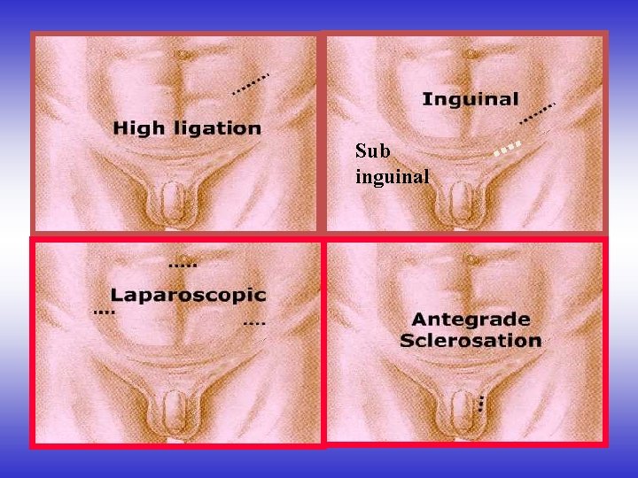 Sub inguinal 