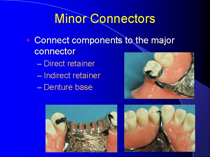 Minor Connectors • Connect components to the major connector – Direct retainer – Indirect