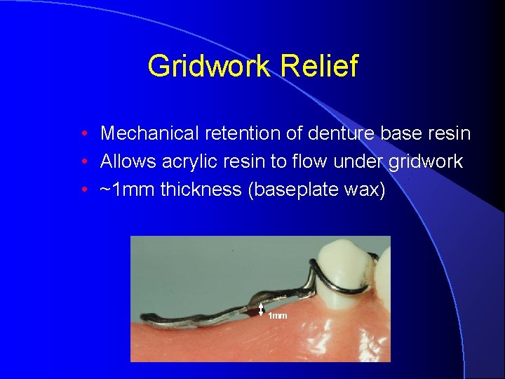 Gridwork Relief • Mechanical retention of denture base resin • Allows acrylic resin to