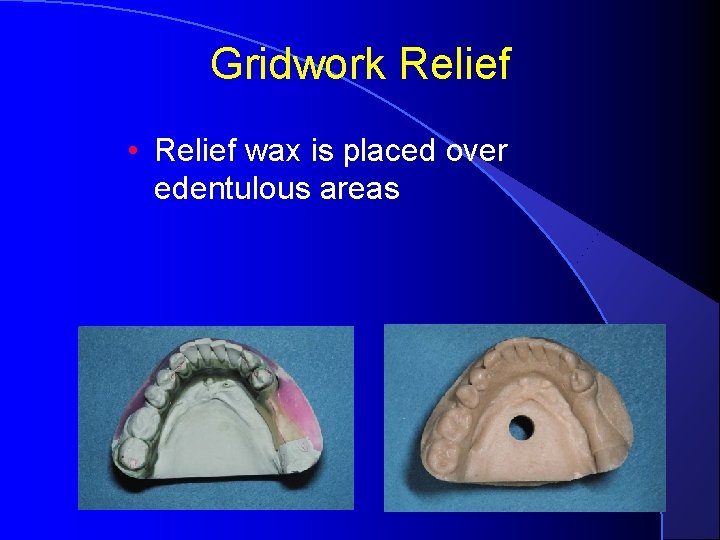 Gridwork Relief • Relief wax is placed over edentulous areas 