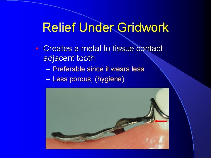 Relief Under Gridwork • Creates a metal to tissue contact adjacent tooth – Preferable