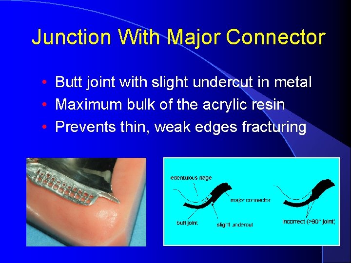 Junction With Major Connector • Butt joint with slight undercut in metal • Maximum