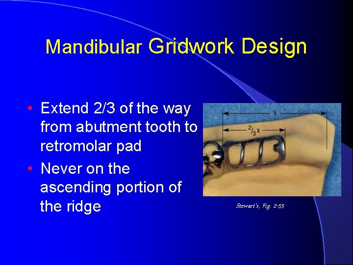 Mandibular Gridwork Design • Extend 2/3 of the way from abutment tooth to retromolar