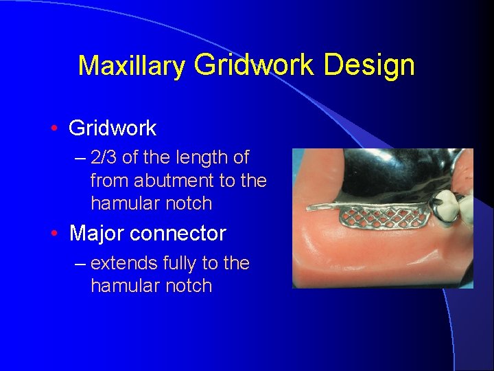 Maxillary Gridwork Design • Gridwork – 2/3 of the length of from abutment to