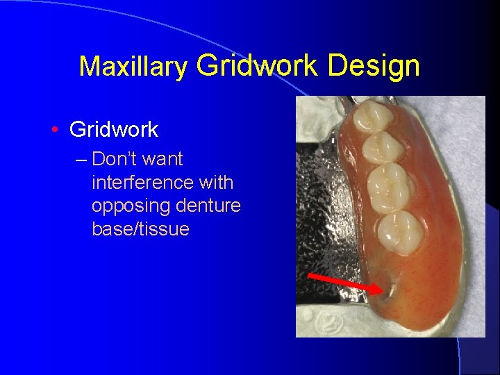 Maxillary Gridwork Design • Gridwork – Don’t want interference with opposing denture base/tissue 