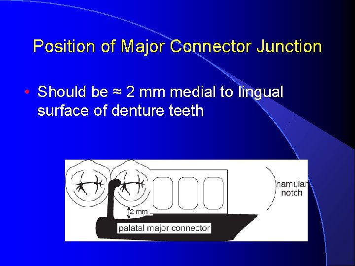 Position of Major Connector Junction • Should be ≈ 2 mm medial to lingual