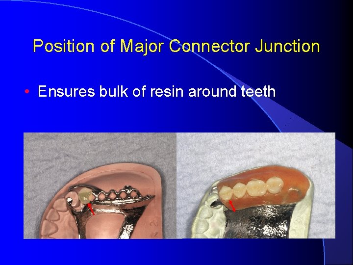 Position of Major Connector Junction • Ensures bulk of resin around teeth 