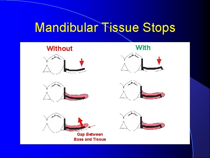 Mandibular Tissue Stops Without Gap Between Base and Tissue 
