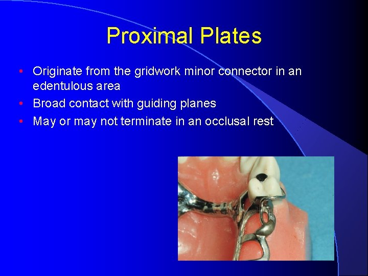 Proximal Plates • Originate from the gridwork minor connector in an edentulous area •