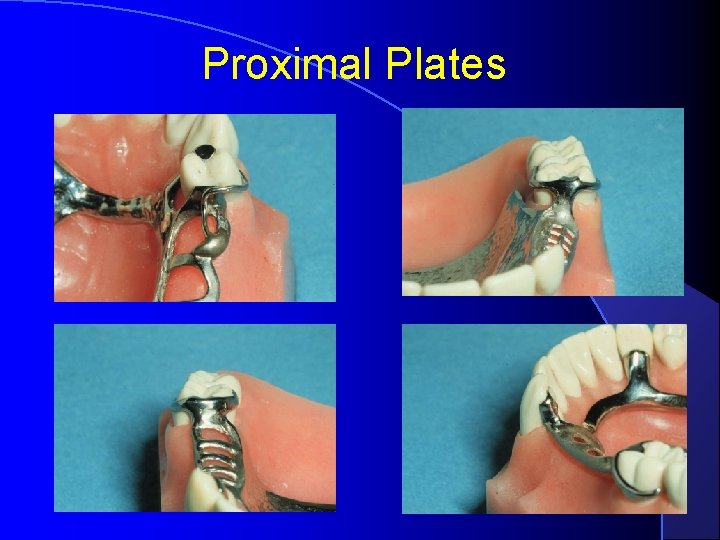 Proximal Plates 