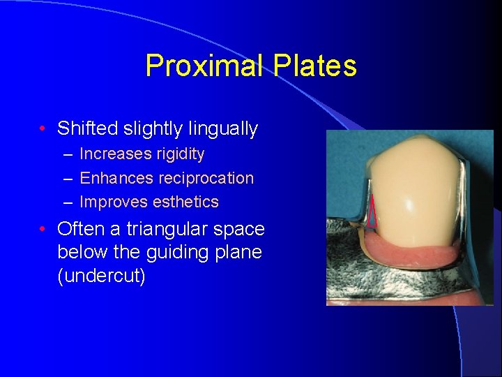 Proximal Plates • Shifted slightly lingually – Increases rigidity – Enhances reciprocation – Improves