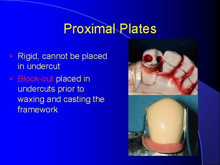 Proximal Plates • Rigid, cannot be placed in undercut • Block-out placed in undercuts