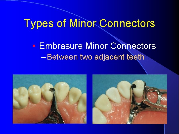 Types of Minor Connectors • Embrasure Minor Connectors – Between two adjacent teeth 