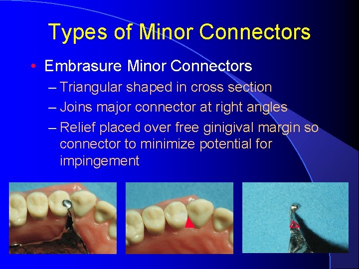 Types of Minor Connectors • Embrasure Minor Connectors – Triangular shaped in cross section