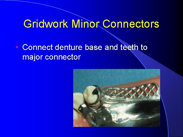 Gridwork Minor Connectors • Connect denture base and teeth to major connector 