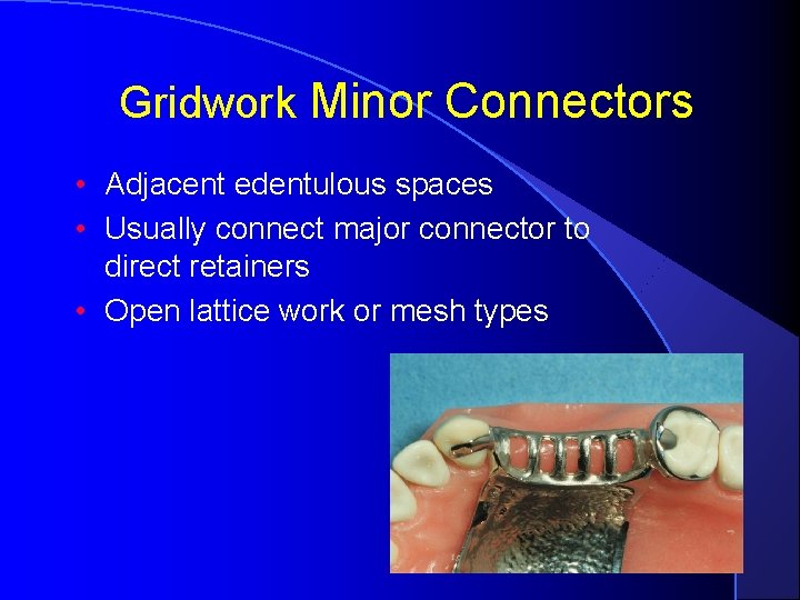 Gridwork Minor Connectors • Adjacent edentulous spaces • Usually connect major connector to direct