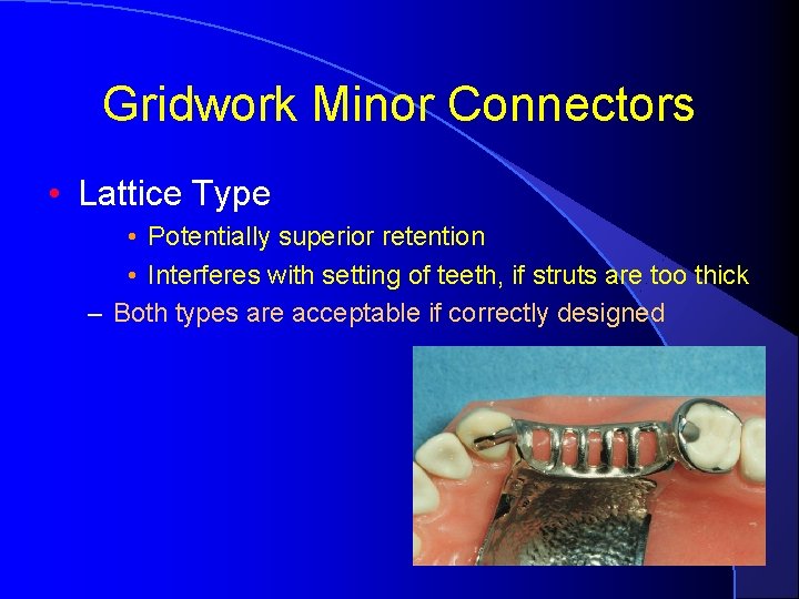 Gridwork Minor Connectors • Lattice Type • Potentially superior retention • Interferes with setting
