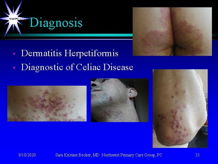 Diagnosis • • Dermatitis Herpetiformis Diagnostic of Celiac Disease 9/18/2020 Sara Kristine Becker, MD