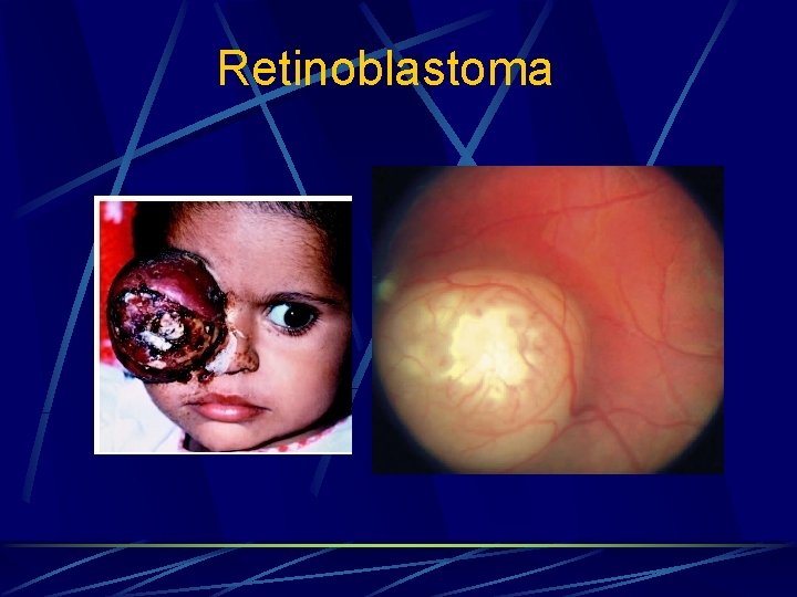 Retinoblastoma 