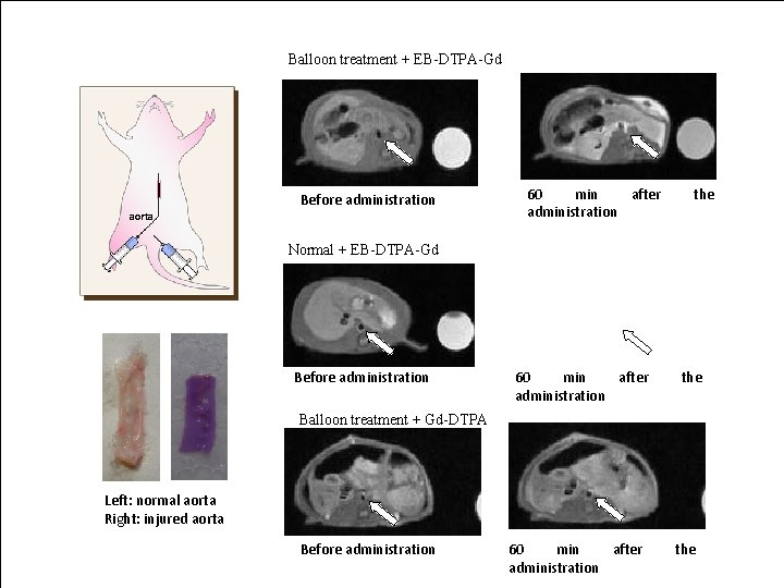 Balloon treatment + EB-DTPA-Gd Before administration aorta 60 min after administration the Normal +