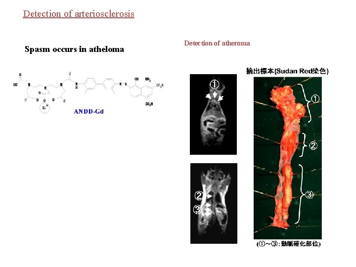 Detection of arteriosclerosis Spasm occurs in atheloma Detection of atheroma 