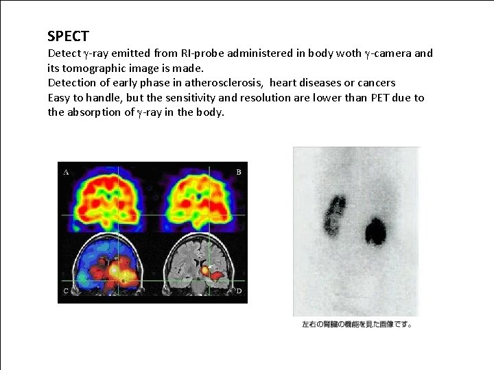 SPECT Detect g-ray emitted from RI-probe administered in body woth g-camera and its tomographic