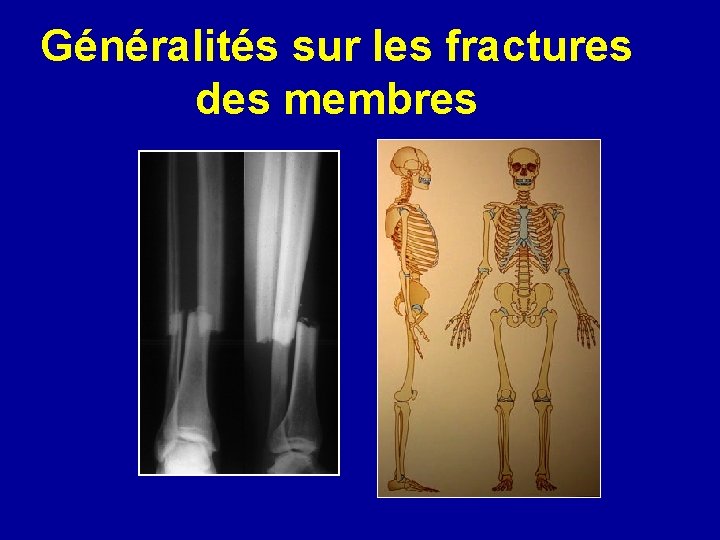 Généralités sur les fractures des membres 