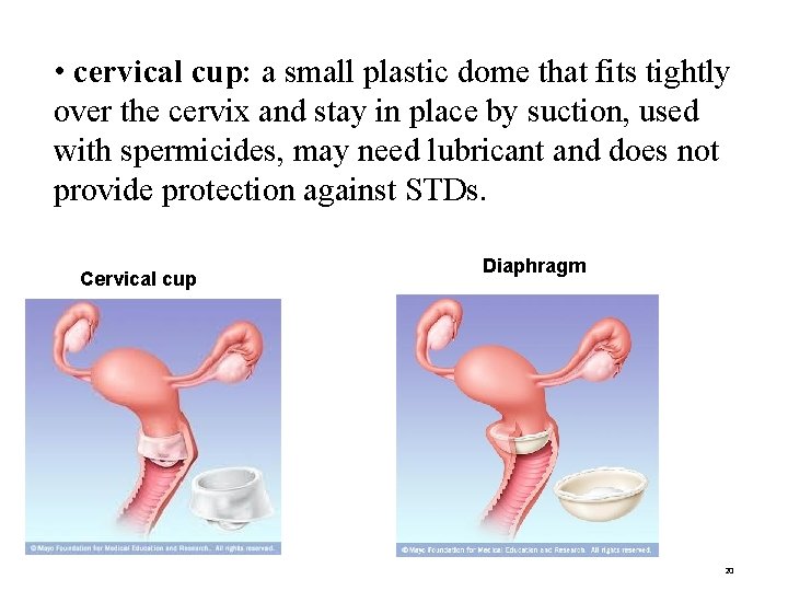  • cervical cup: a small plastic dome that fits tightly over the cervix