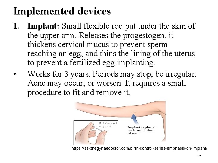 Implemented devices 1. Implant: Small flexible rod put under the skin of the upper